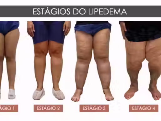 Lipedema: Como Tratar