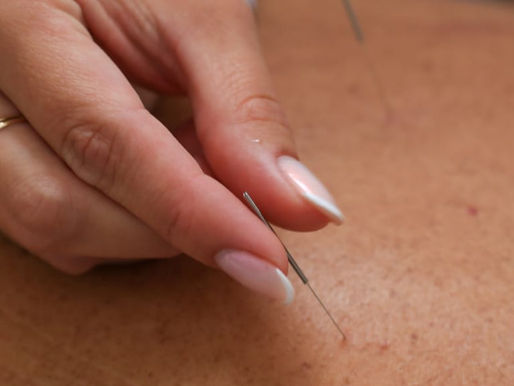 Acupuntura: O Caminho Natural para o Relaxamento e Bem-Estar