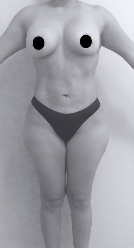 patient's body before BBL surgery in charlotte