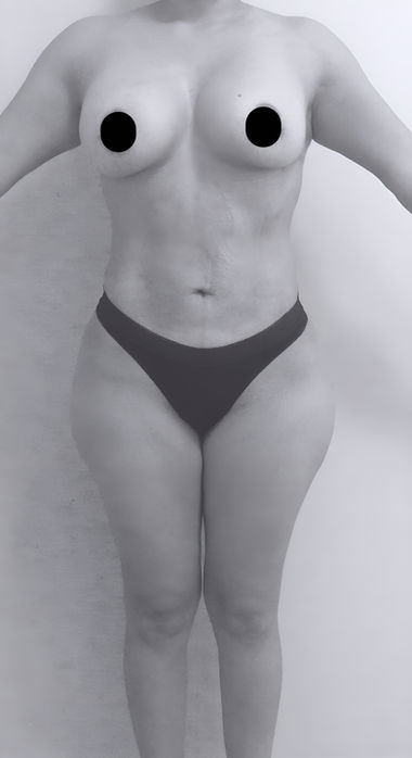 patient's body before BBL surgery in charlotte