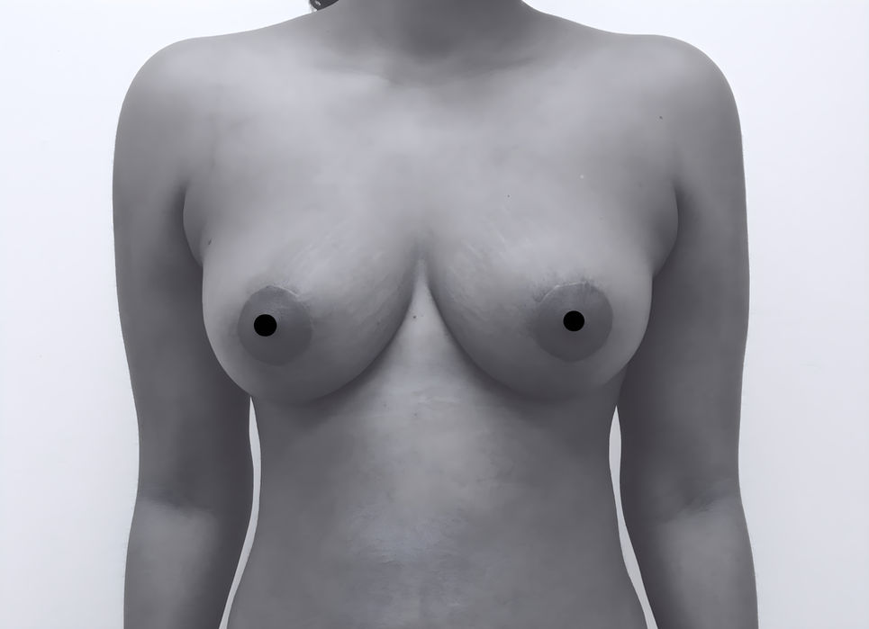 patient's breasts after breast reduction in Charlotte