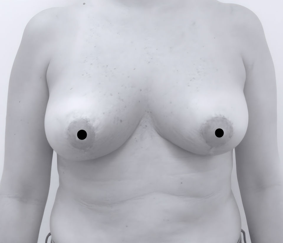 patient's breasts after breast reduction in fort mill