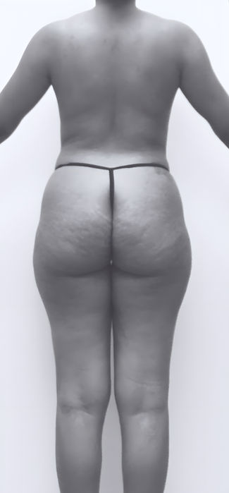 patient's body before liposuction in fort mill 