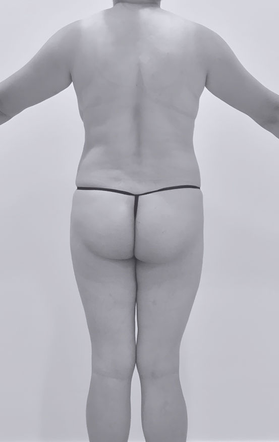 patient's body before BBL surgery in charlotte