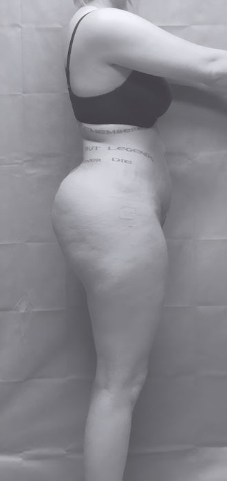 patient's side after BBL surgery in charlotte
