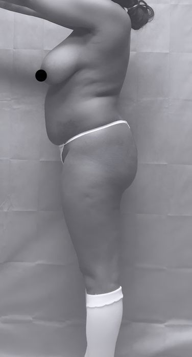 patient's side before BBL surgery in charlotte