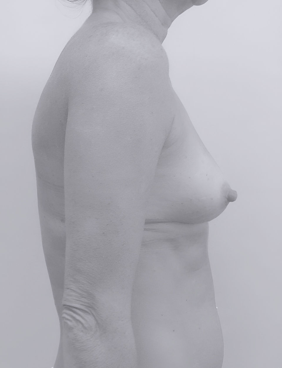 image of patient's breasts before breast augmentation in Charlotte