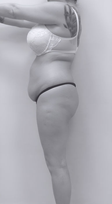 patient side before BBL surgery in charlotte