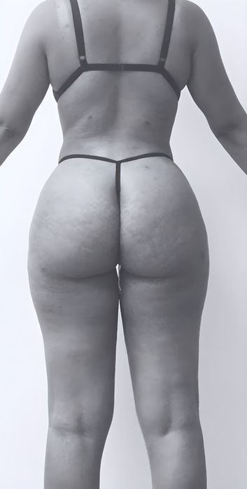 patient's body after liposuction in charlotte 