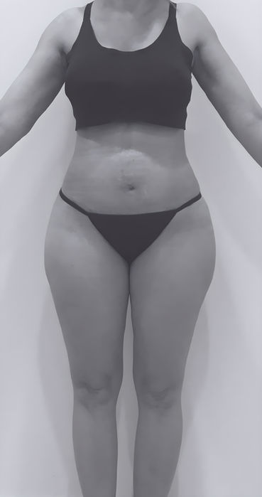 patient's body after liposuction in fort mill 