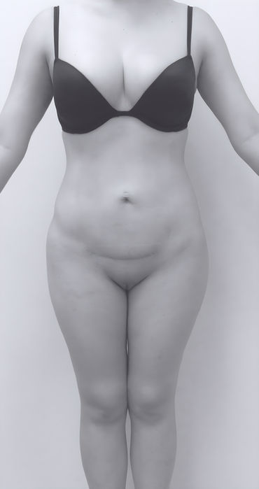 patient's body after liposuction in charlotte 