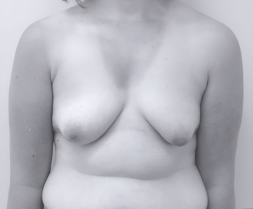 patient's breasts before breast lift in Charlotte