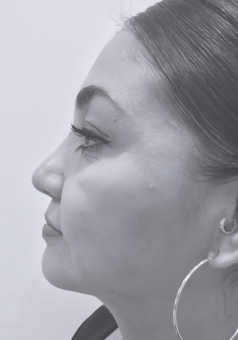 patient's nose after rhinoplasty in charlotte 