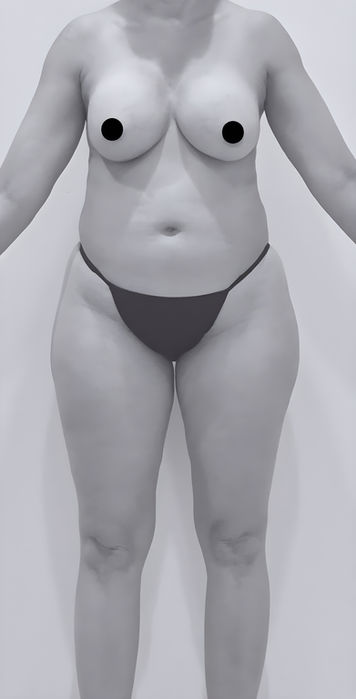 patient's body before liposuction in fort mill 