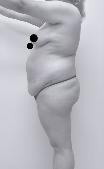 image of patient's body before lipoabdominoplasty in Charlotte