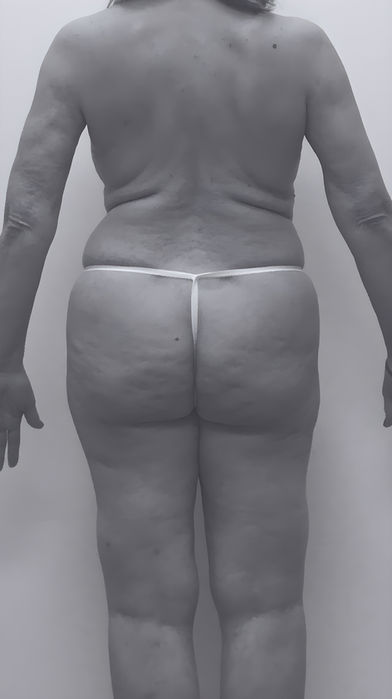 patient's body before liposuction in fort mill 