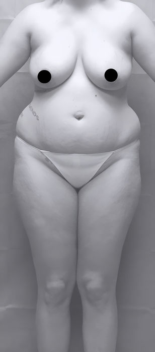 patient's body before BBL surgery in charlotte