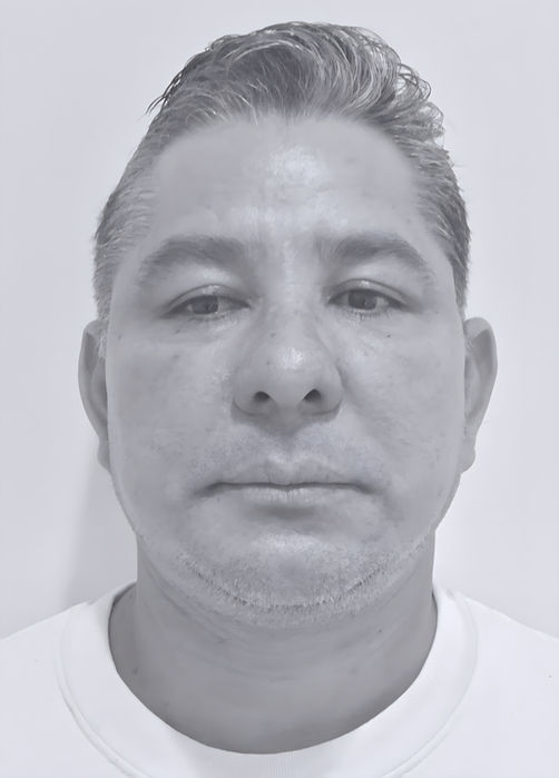 patient's face after face lift 