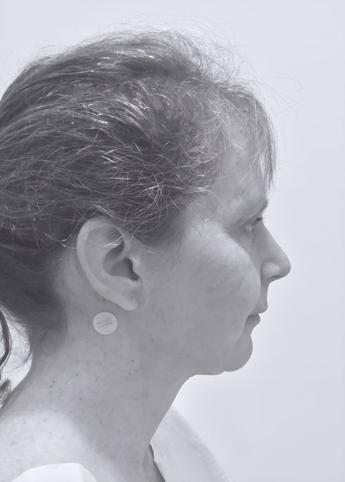 patient's face before face lift 