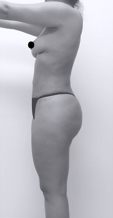 patient's side after BBL surgery in charlotte