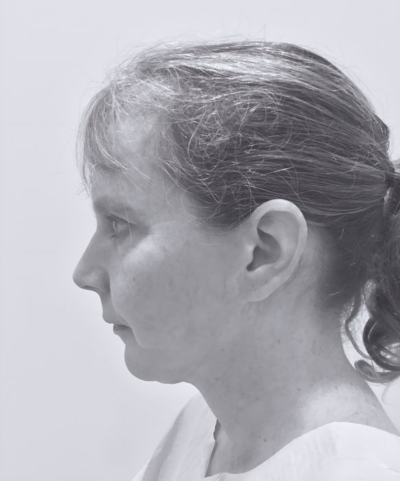patient's face before face lift 