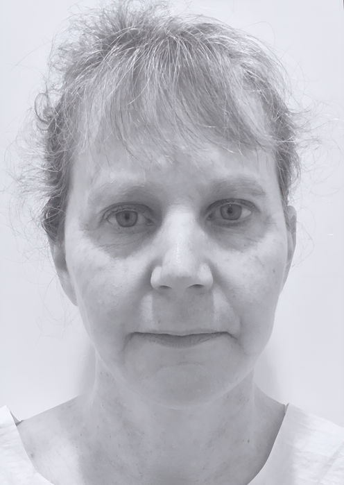patient's face before face lift 