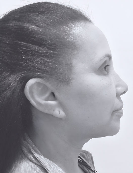 patient's face after face lift 