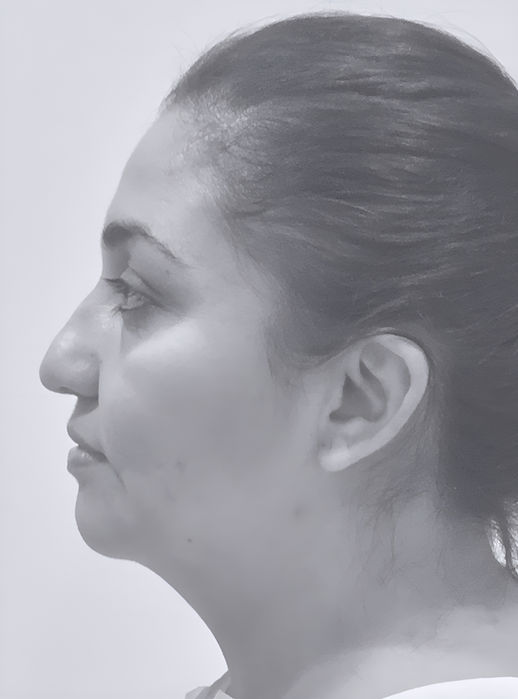 patient's nose before rhinoplasty in charlotte 