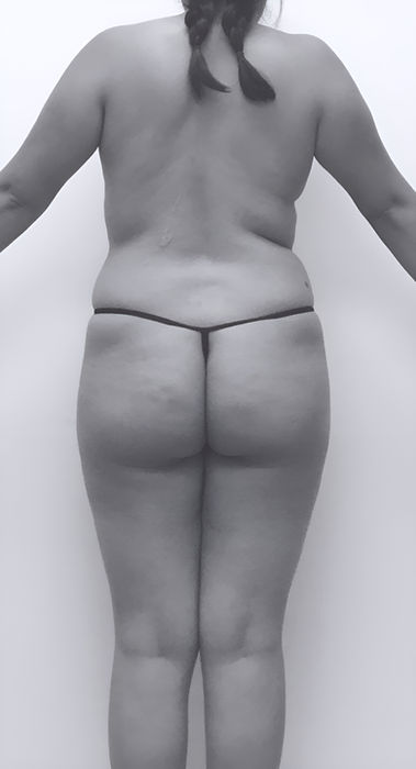 patient's butt before BBL surgery in charlotte