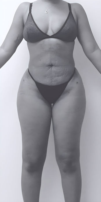 patient's body before liposuction in fort mill 