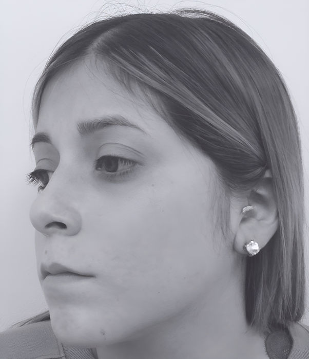 patient's nose after rhinoplasty in charlotte 
