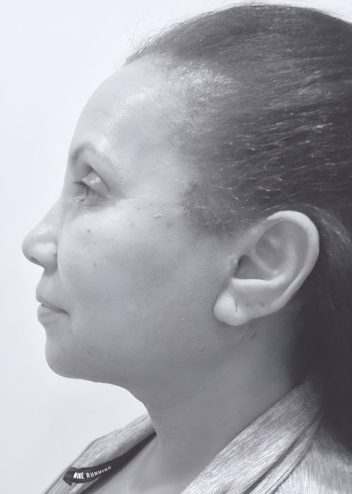patient's face after face lift 