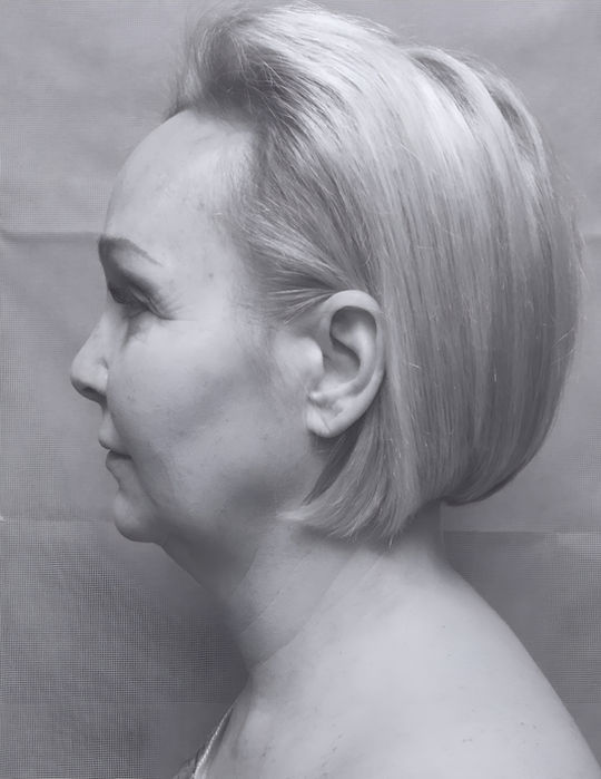 patient's face before face lift 
