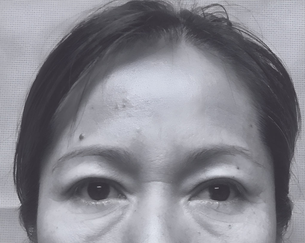 Patient's eyelids before upper bleph surgery in charlotte