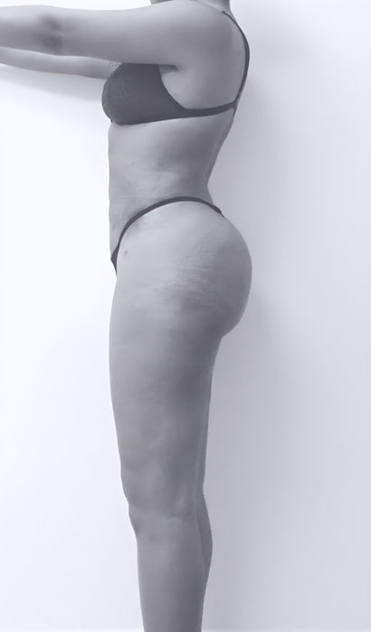 patient's body after liposuction in fort mill 