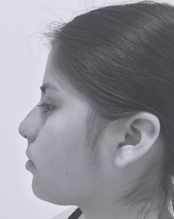 patient's nose before rhinoplasty in charlotte 