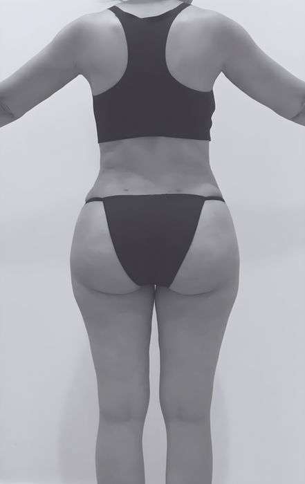 patient's body after liposuction in fort mill 