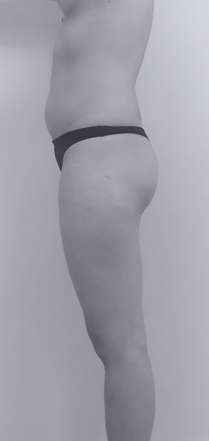patient's body before BBL surgery in charlotte
