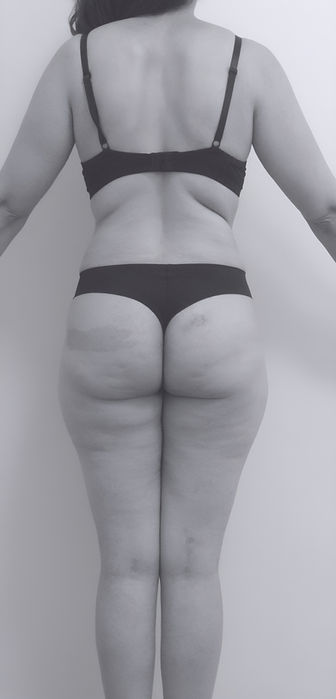 image of patient's body after lipoabdominoplasty in Charlotte