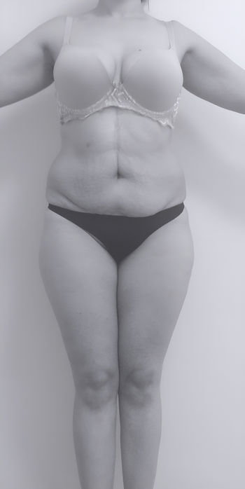 image of patient's body before lipoabdominoplasty in Charlotte