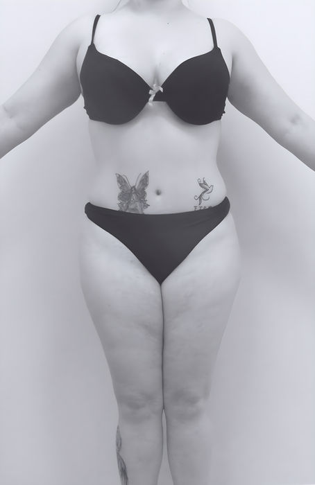 patient's body before revision abdominoplasty in charlotte