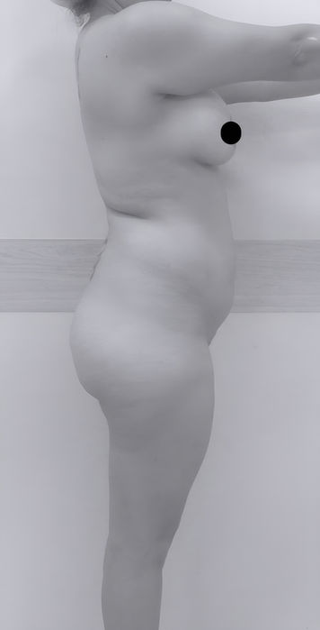 patient's side before BBL surgery in charlotte