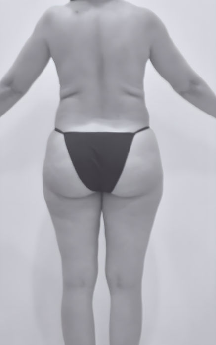 patient's body before liposuction in fort mill 