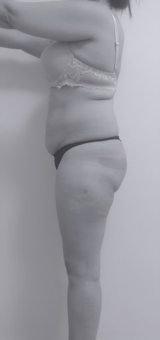 image of patient's body before lipoabdominoplasty in Charlotte