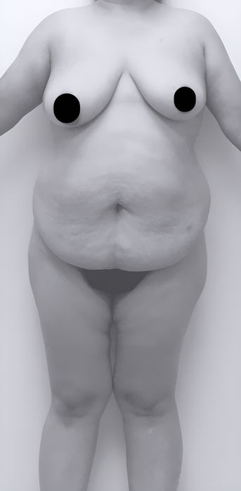 image of patient's body before lipoabdominoplasty in Charlotte