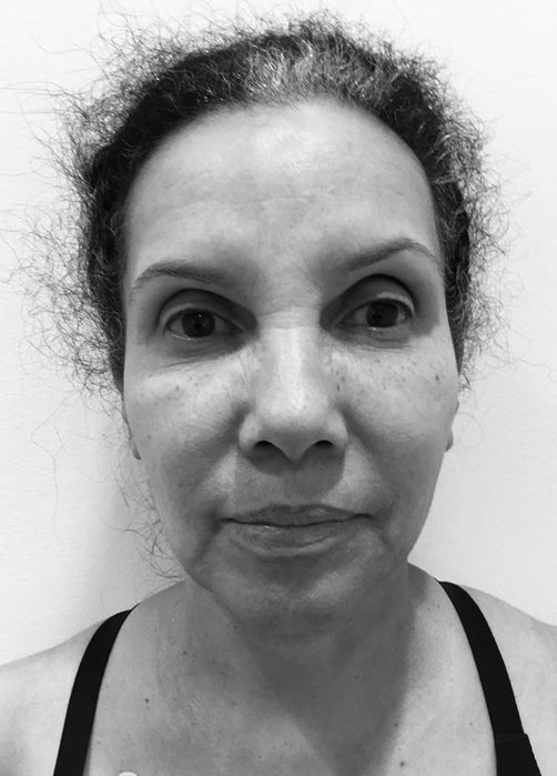 patient's face before face lift 
