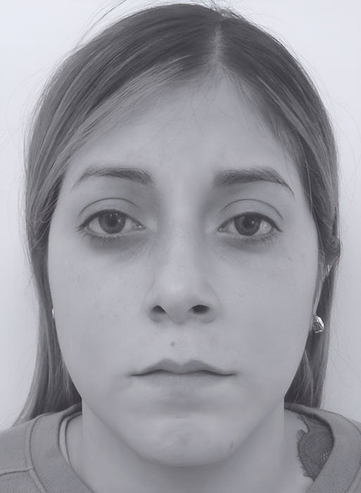 patient's nose after rhinoplasty in charlotte 