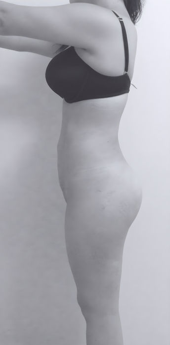 patient's body after liposuction in charlotte 