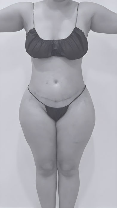 image of patient's body after lipoabdominoplasty in Charlotte