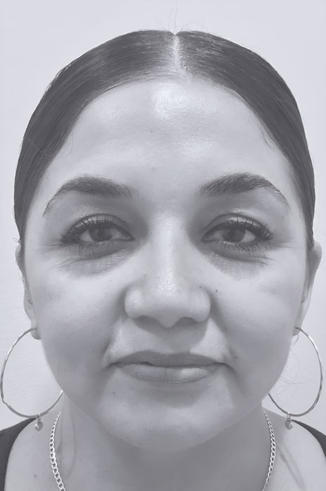 patient's nose after rhinoplasty in charlotte 
